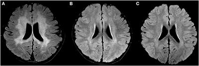 Allogeneic Hematopoietic Stem Cell Transplantation for PEX1-Related Zellweger Spectrum Disorder: A Case Report and Literature Review